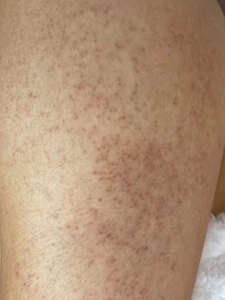 Arms & Legs before treatment