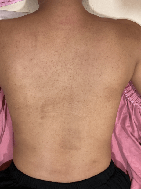 Back After 5–15 sessions
