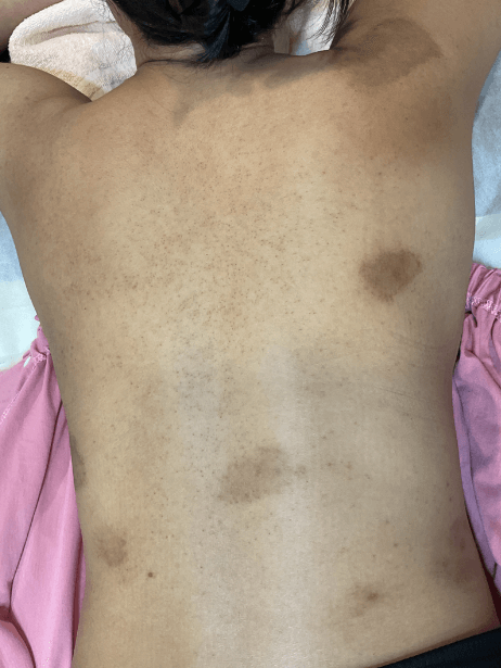 Back before treatment