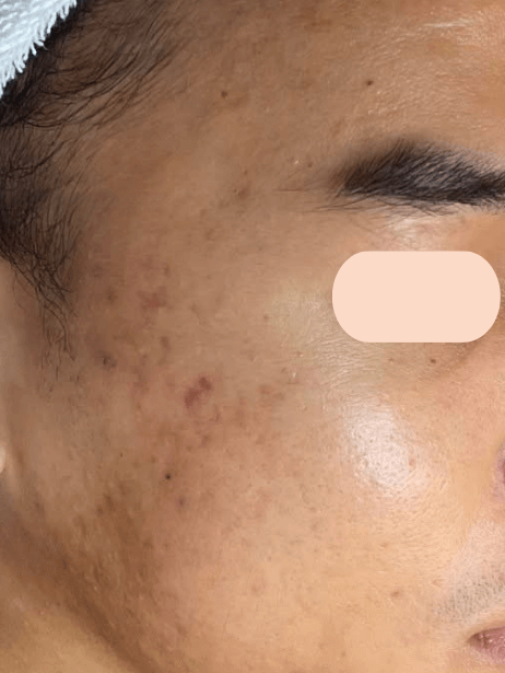 Face After 5–15 sessions