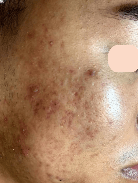 Face before treatment