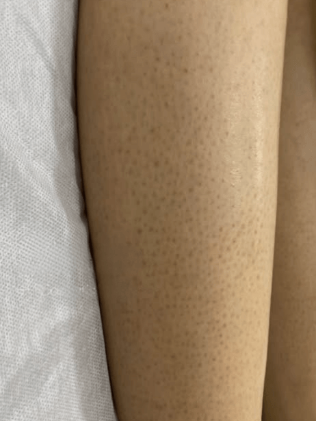 Arms & Legs before treatment