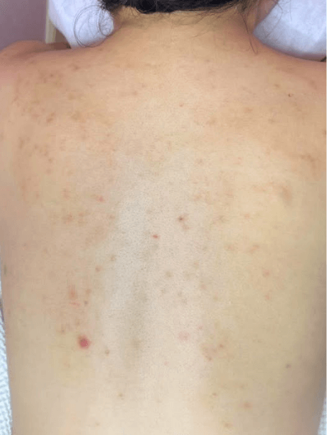 Back After 5–15 sessions