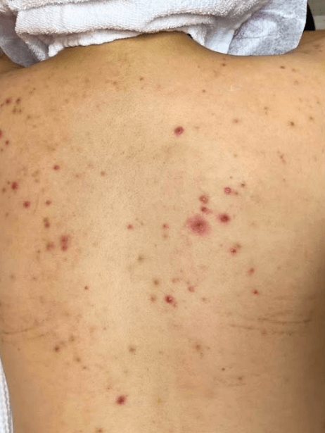 Back before treatment