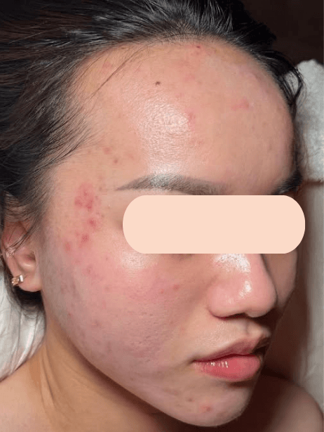 Face After 5–15 sessions