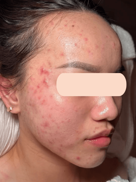 Face before treatment