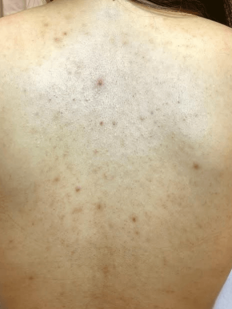 Back before treatment