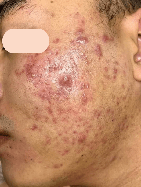 Face before treatment