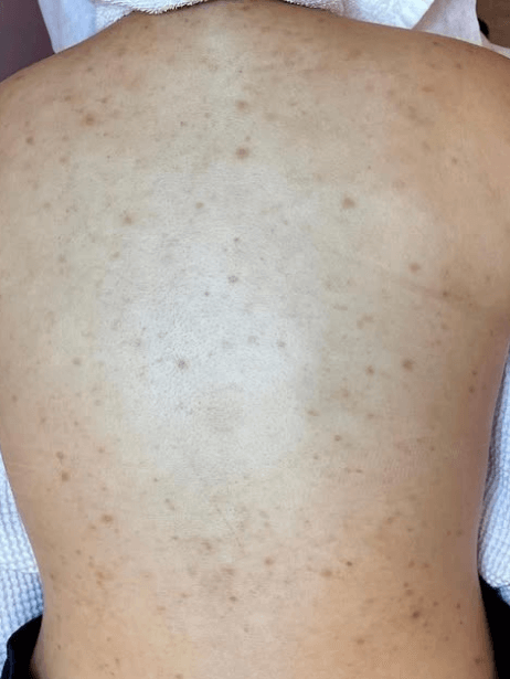 Back After 5–15 sessions