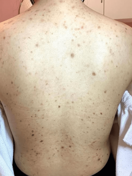 Back before treatment