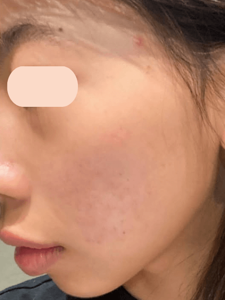 Face After 5–15 sessions