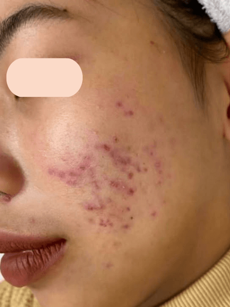 Face before treatment
