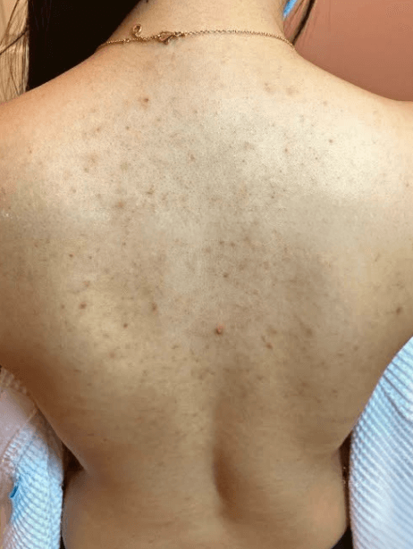 Back before treatment