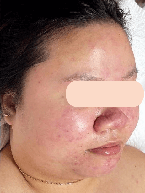 Face After 5–15 sessions