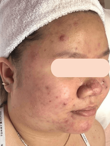 Face before treatment