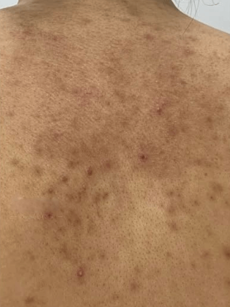 Back before treatment