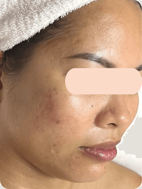 Face After 5–15 sessions