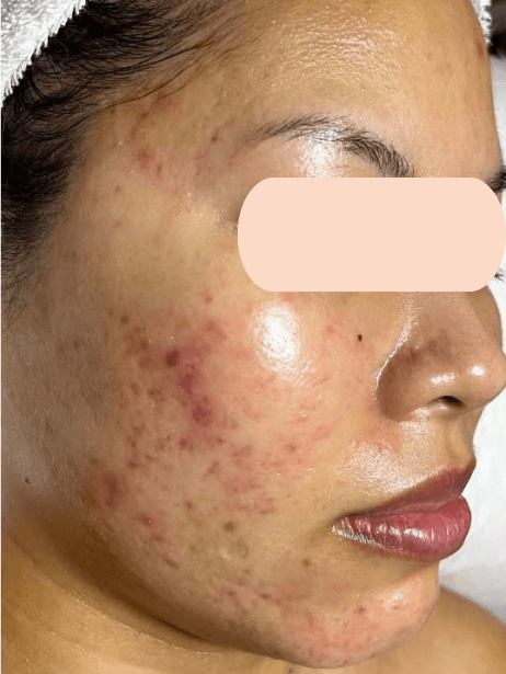 Face before treatment