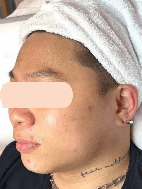 Face After 5–15 sessions