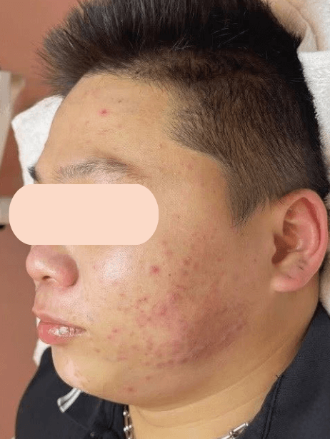 Face before treatment