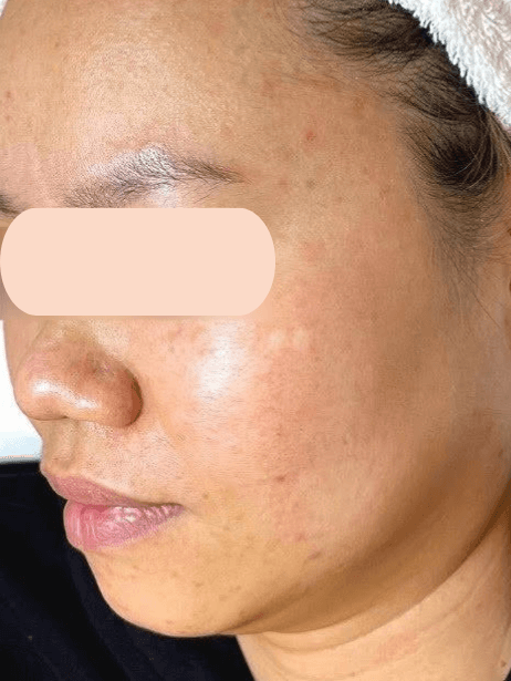 Face After 5–15 sessions