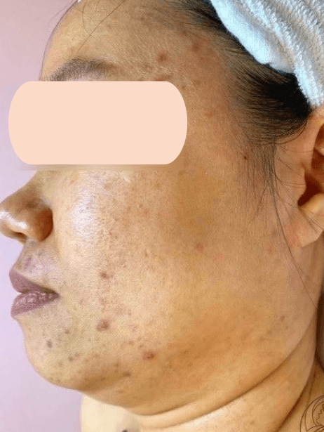 Face before treatment