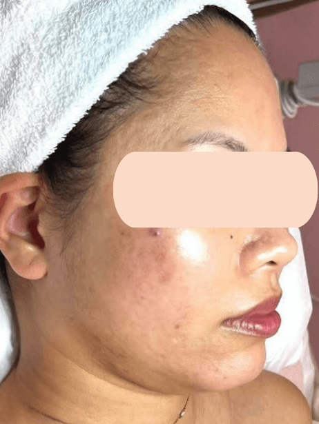 Face After 5–15 sessions