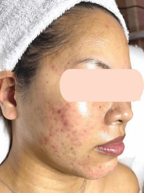 Face before treatment