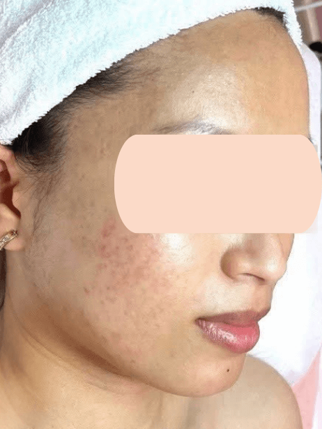 Face After 5–15 sessions
