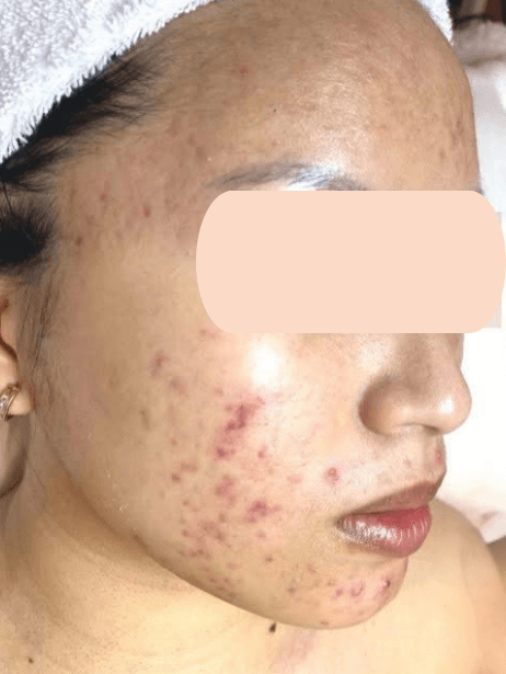 Face before treatment