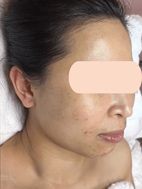 Face After 5–15 sessions