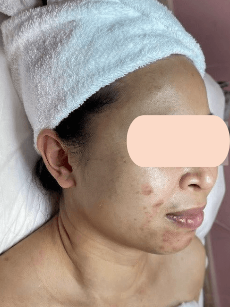 Face before treatment