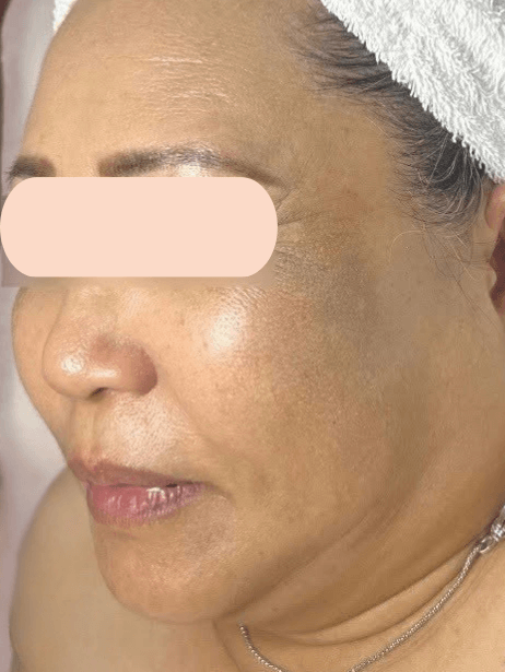 Face After 5–15 sessions