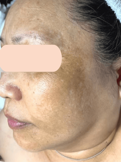 Face before treatment
