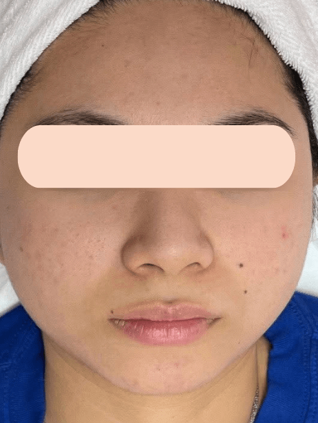 Face After 5–15 sessions