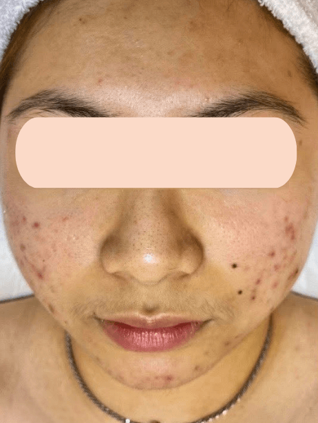 Face before treatment