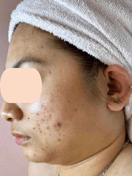 Face before treatment