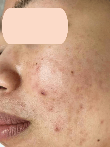Face before treatment