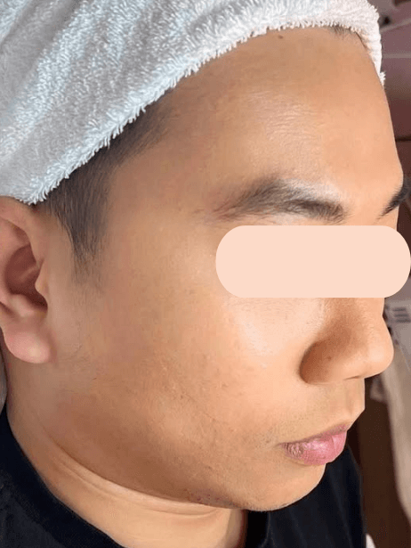 Face After 5–15 sessions