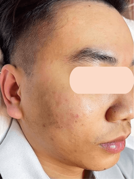 Face before treatment
