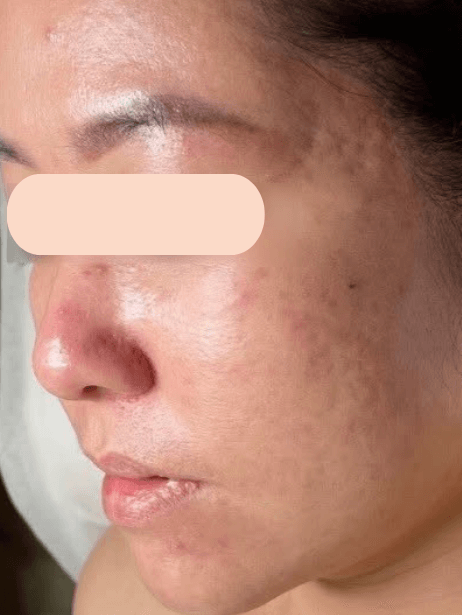 Face After 5–15 sessions