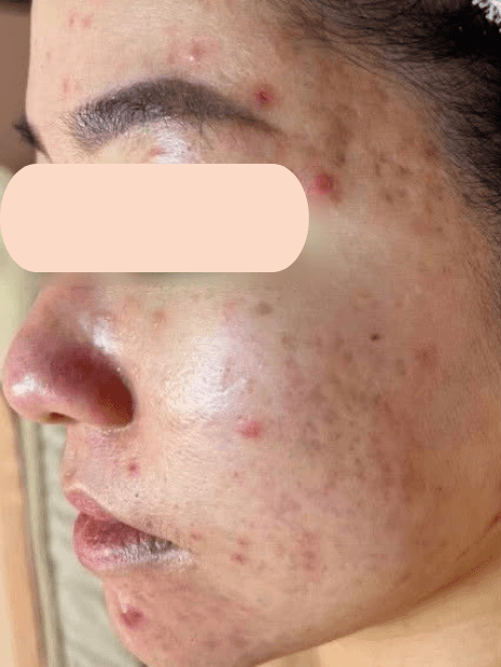 Face before treatment