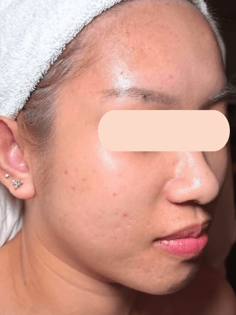 Face After 5–15 sessions