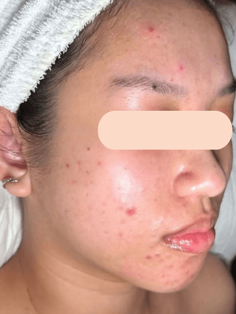 Face before treatment