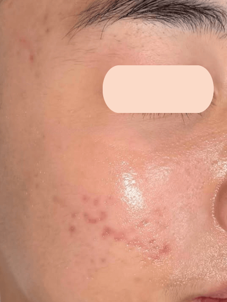 Face After 5–15 sessions