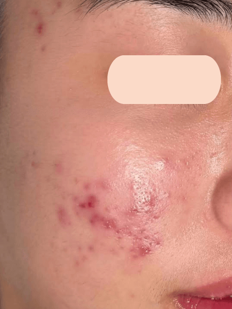 Face before treatment