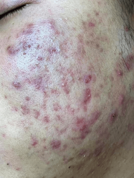 Face before treatment
