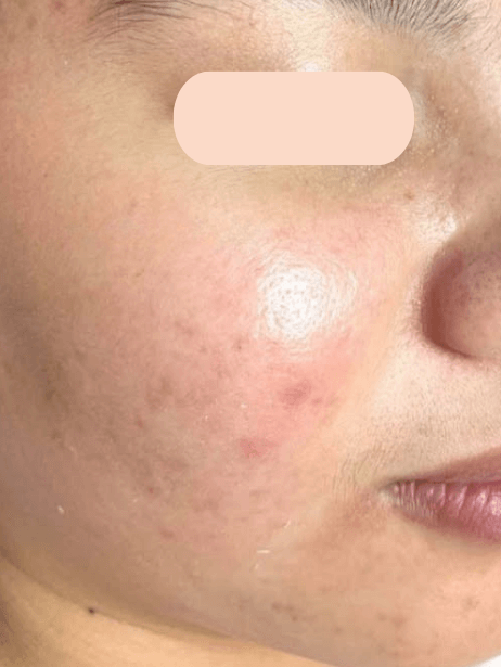 Face After 5–15 sessions