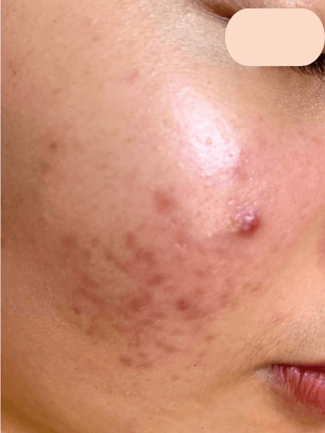 Face before treatment