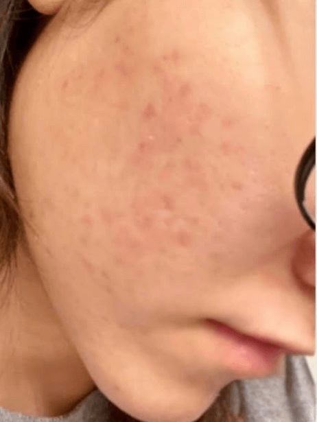 Face After 5–15 sessions
